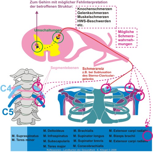 Reflexzonen - &Uuml;bertragener Schmerz - referred pain